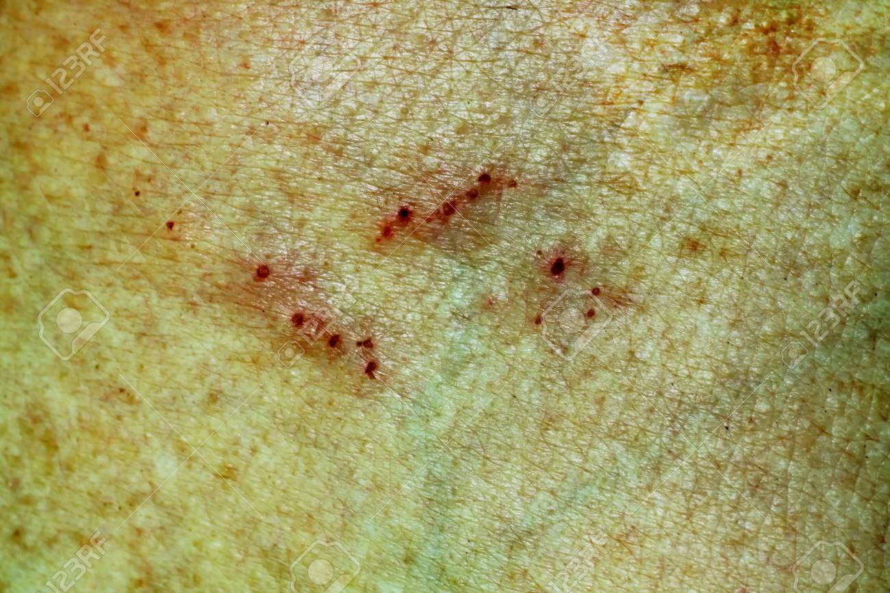 切り傷や皮膚のひっかき傷 傷や擦り傷 の写真素材 画像素材 Image