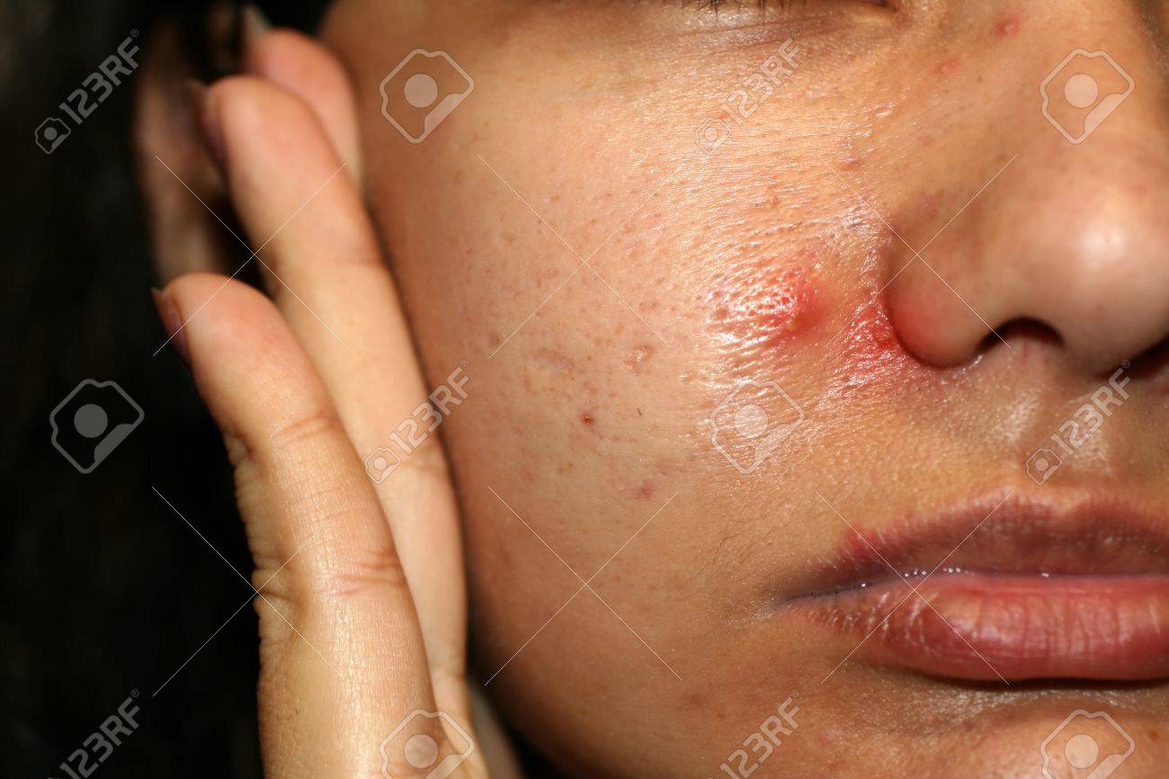 顔の皮膚の炎症 赤にきびが化膿 にきび ケロイド 拡大毛穴 の写真素材 画像素材 Image 顔の皮膚の炎症 赤にきびが化膿 にきび ケロイド 拡大毛穴 の写真素材 画像素材 Image