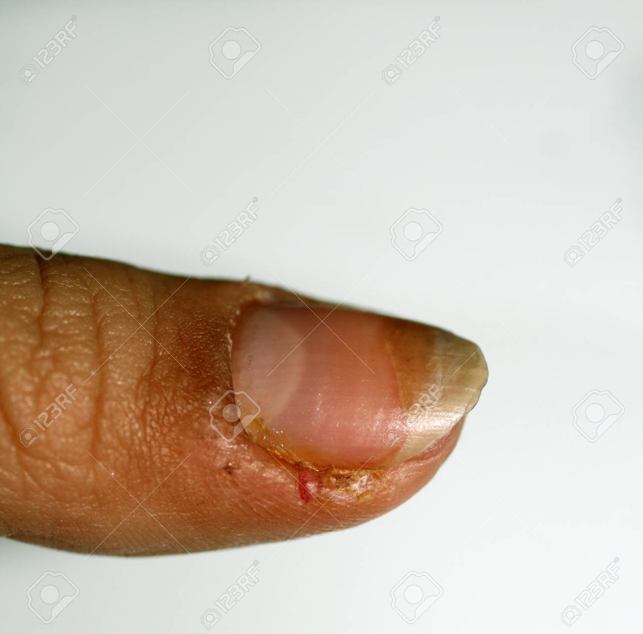 inflammation i fingret inflammation i fingret