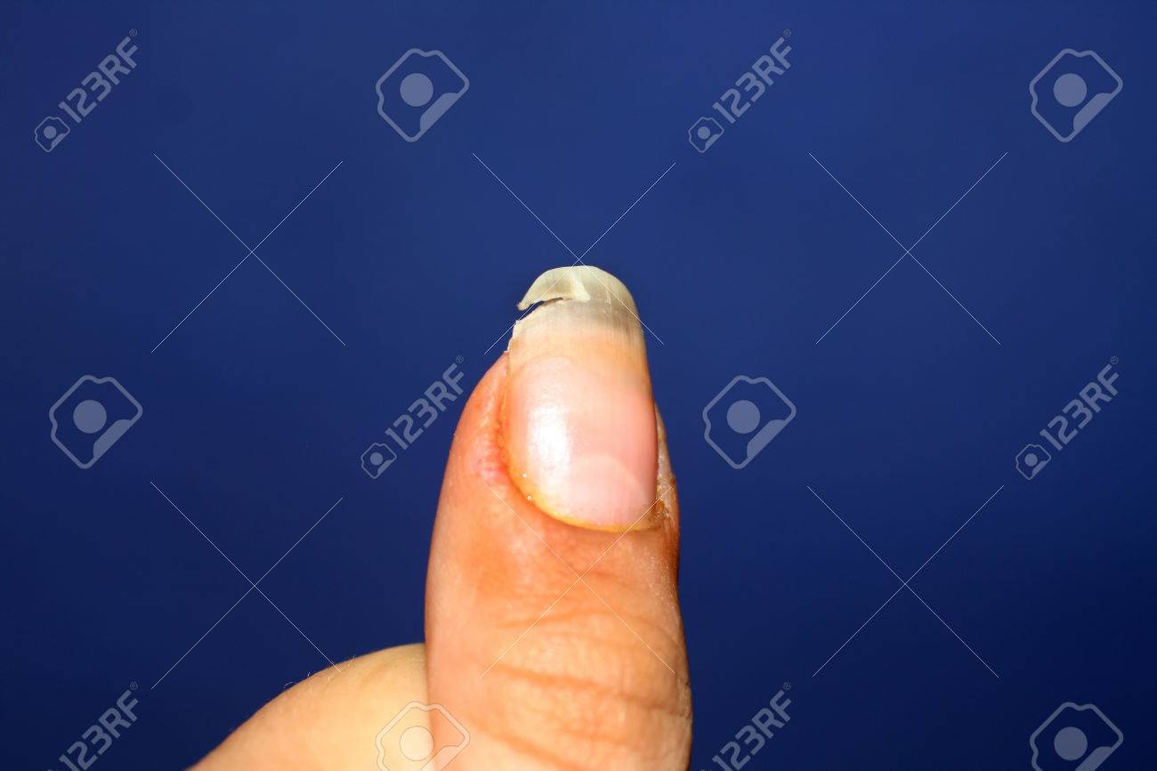 壊れた爪 ビタミン 体内カルシウムの不足 の写真素材 画像素材 Image