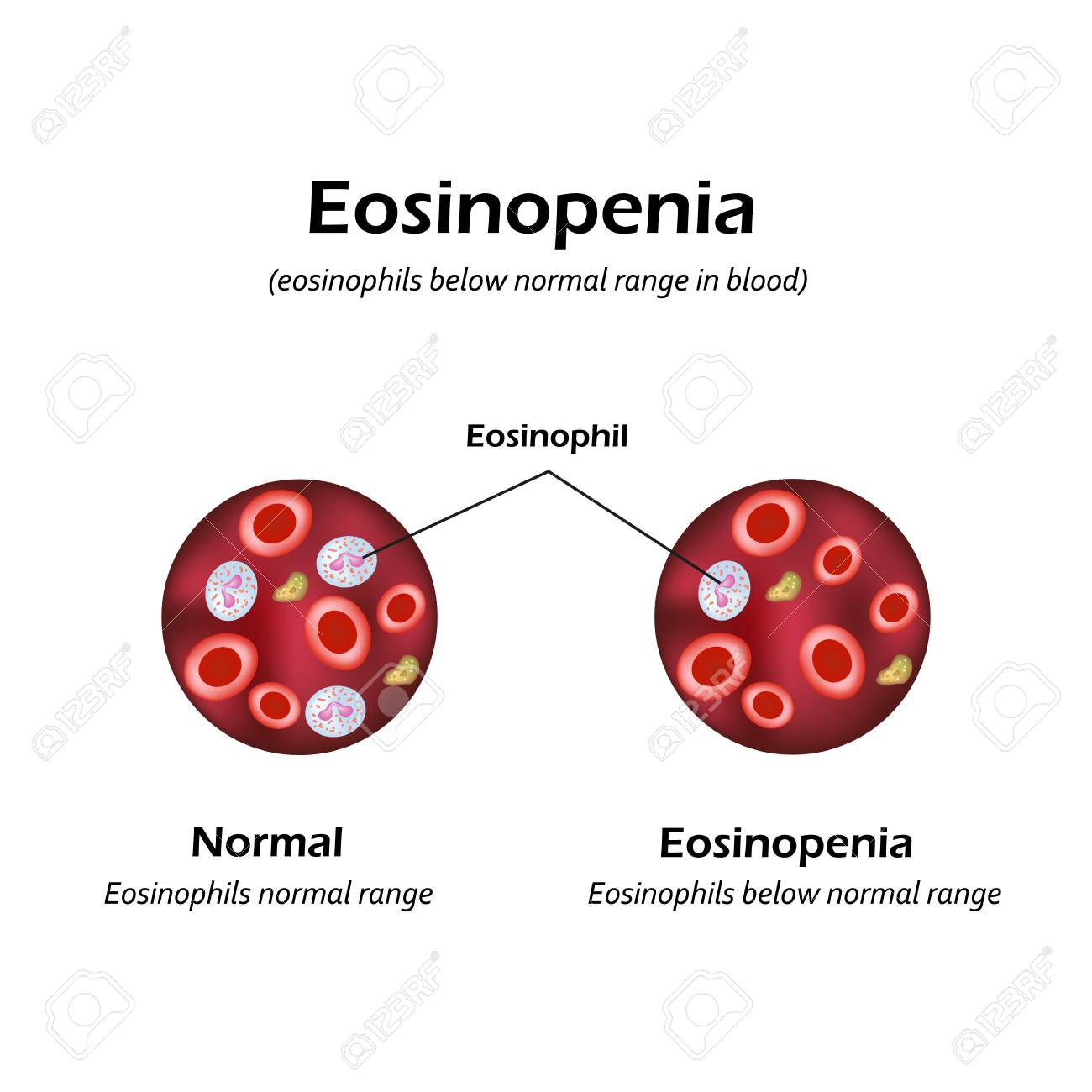 Eosinophils Below Normal Range In Blood. Eosinopenia. Infographics. Vector  Illustration. Royalty Free SVG, Cliparts, Vectors, and Stock Illustration.  Image 88047124.