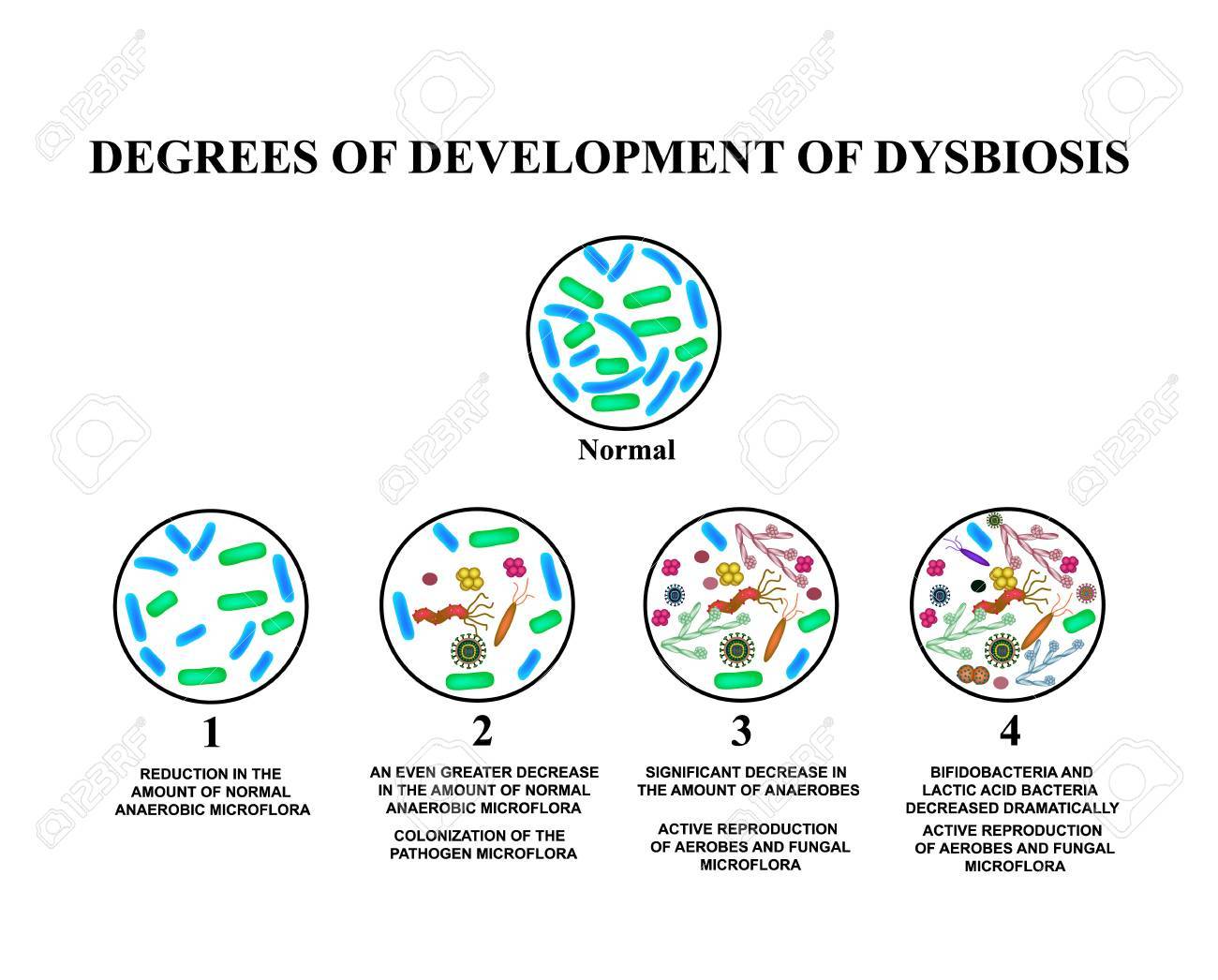 4 degrees of development of dysbiosis. Dysbacteriosis of the intestine. The large intestine. dysbiosis of colon. Bacteria, fungi, viruses. Infographics. Vector illustration on isolated background. - 89088053 4 degrees of development of dysbiosis. Dysbacteriosis of the intestine. The large intestine. dysbiosis of colon. Bacteria, fungi, viruses. Infographics. Vector illustration on isolated background. - 89088053