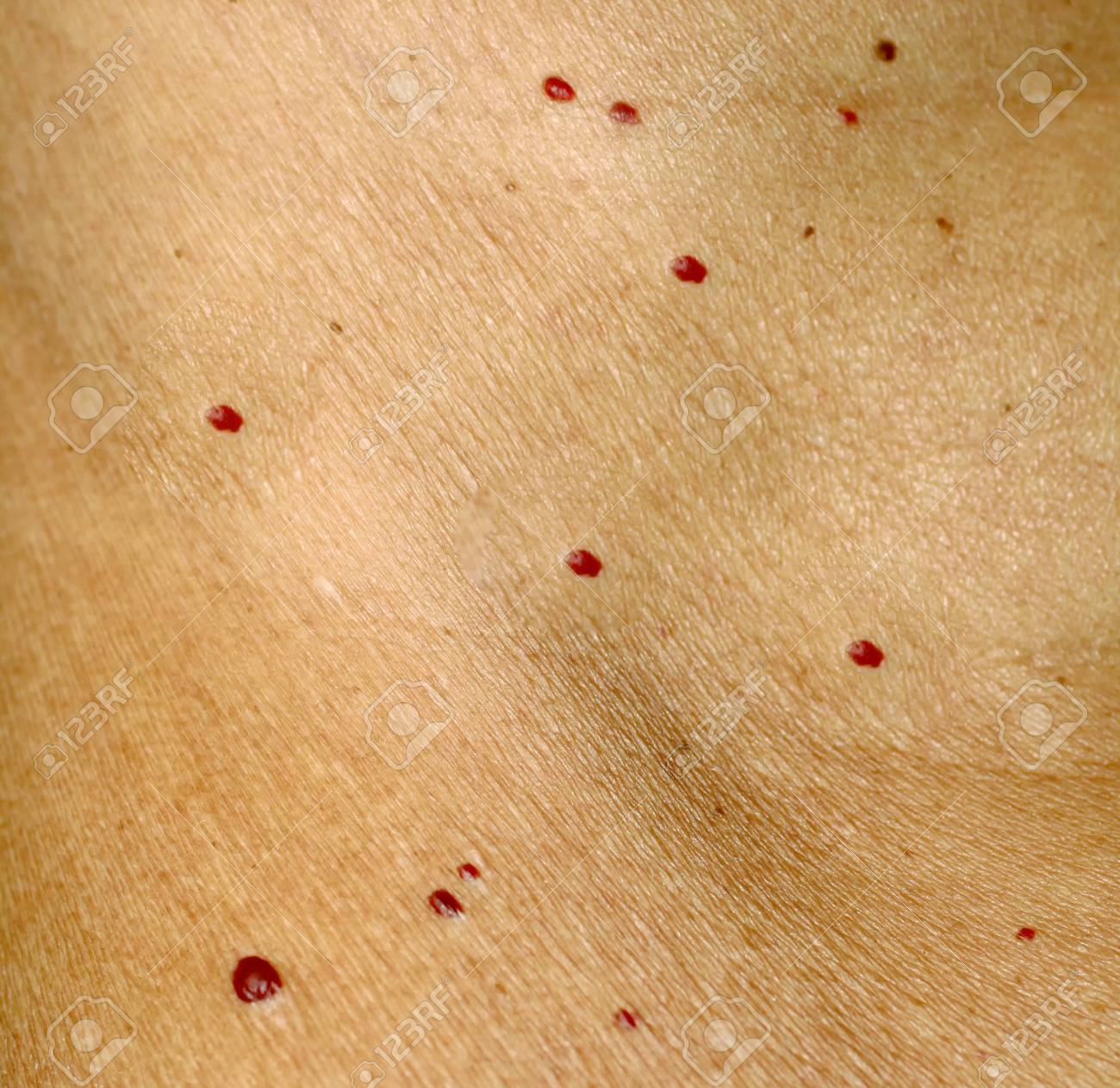 Angioma On The Skin Red Moles On The Body Many Birthmarks Stock Photo Picture And Royalty Free Image Image 92837027