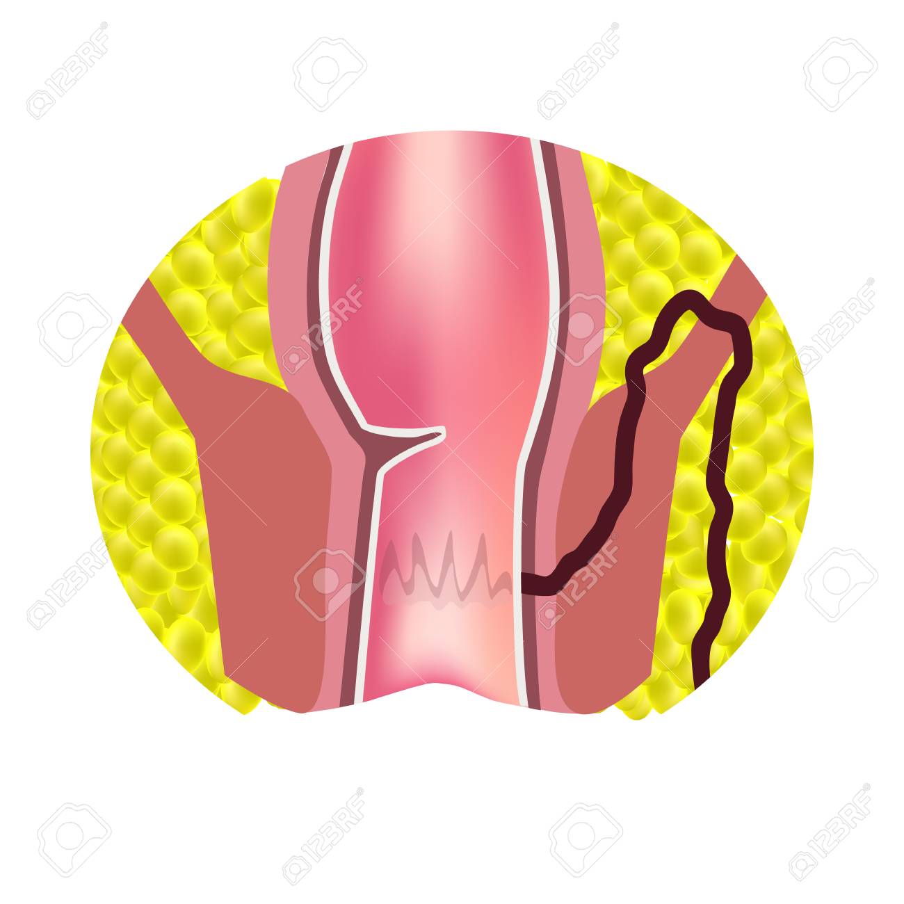 Para anal abscess photos 2