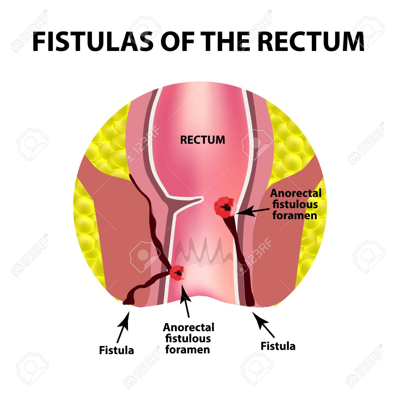 Para anal abscess photos 722