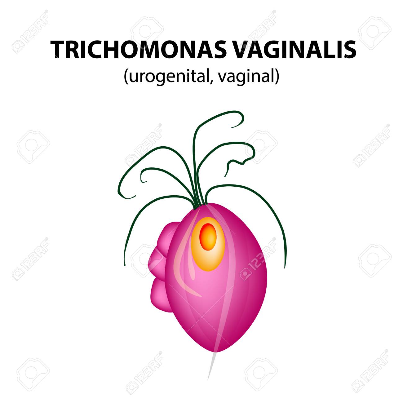 What is Trichomonas Vaginitis What is Trichomonas Vaginitis