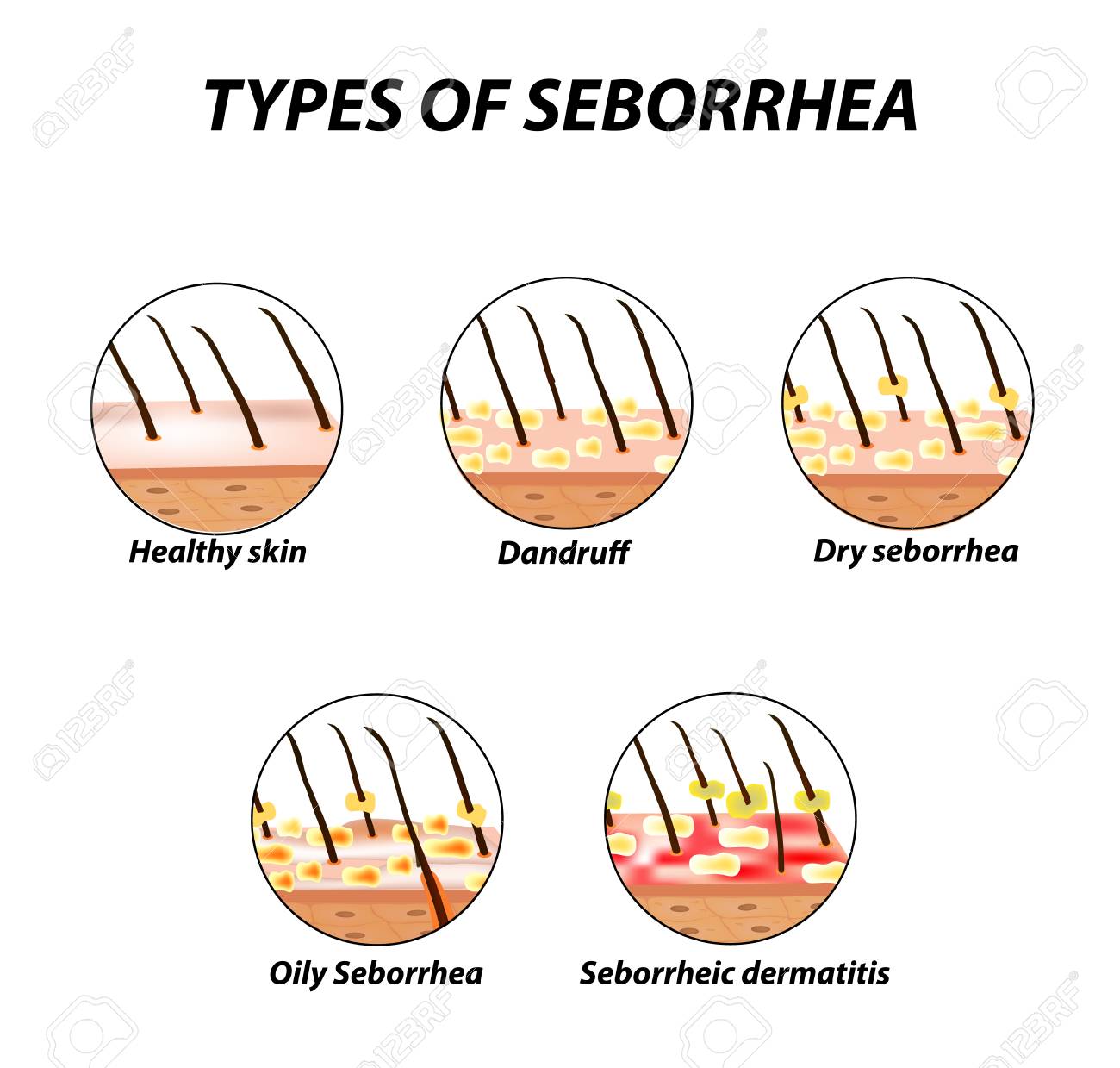 Types Of Seborrhea Seborrhea Skin And Hair Dandruff Seborrheic