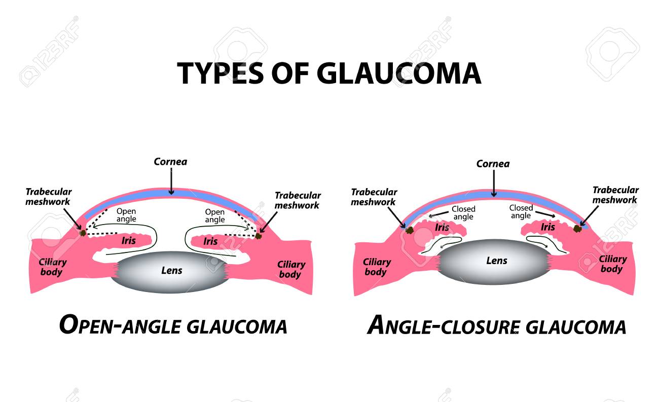 Types of glaucoma. Open-angle and angle-closure glaucoma. The anatomical structure of the eye. Infographics. Vector illustration on isolated background - 124785338 Types of glaucoma. Open-angle and angle-closure glaucoma. The anatomical structure of the eye. Infographics. Vector illustration on isolated background - 124785338
