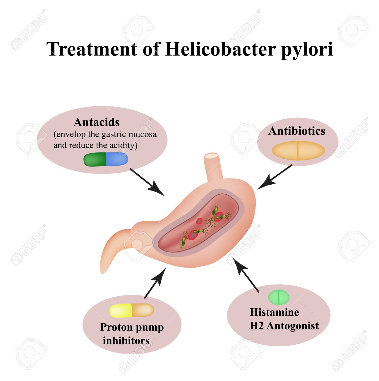 Treatment of Helicobacter pylori. Medications. Antacids, proton pump blockers and H2-histamine blockers. Infographics. Vector illustration on isolated background. - 120562800 Treatment of Helicobacter pylori. Medications. Antacids, proton pump blockers and H2-histamine blockers. Infographics. Vector illustration on isolated background. - 120562800