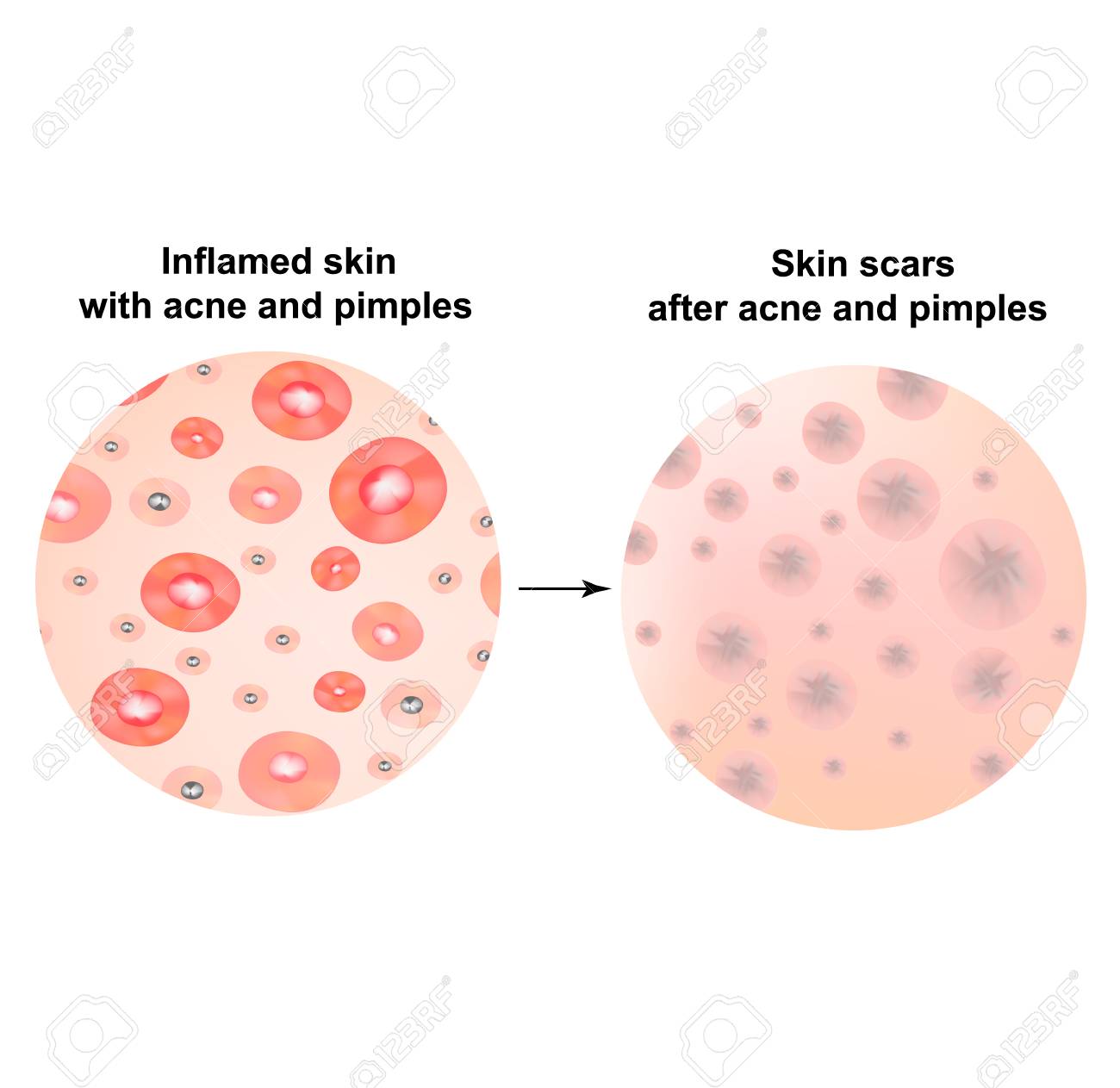 pustule acne treatment