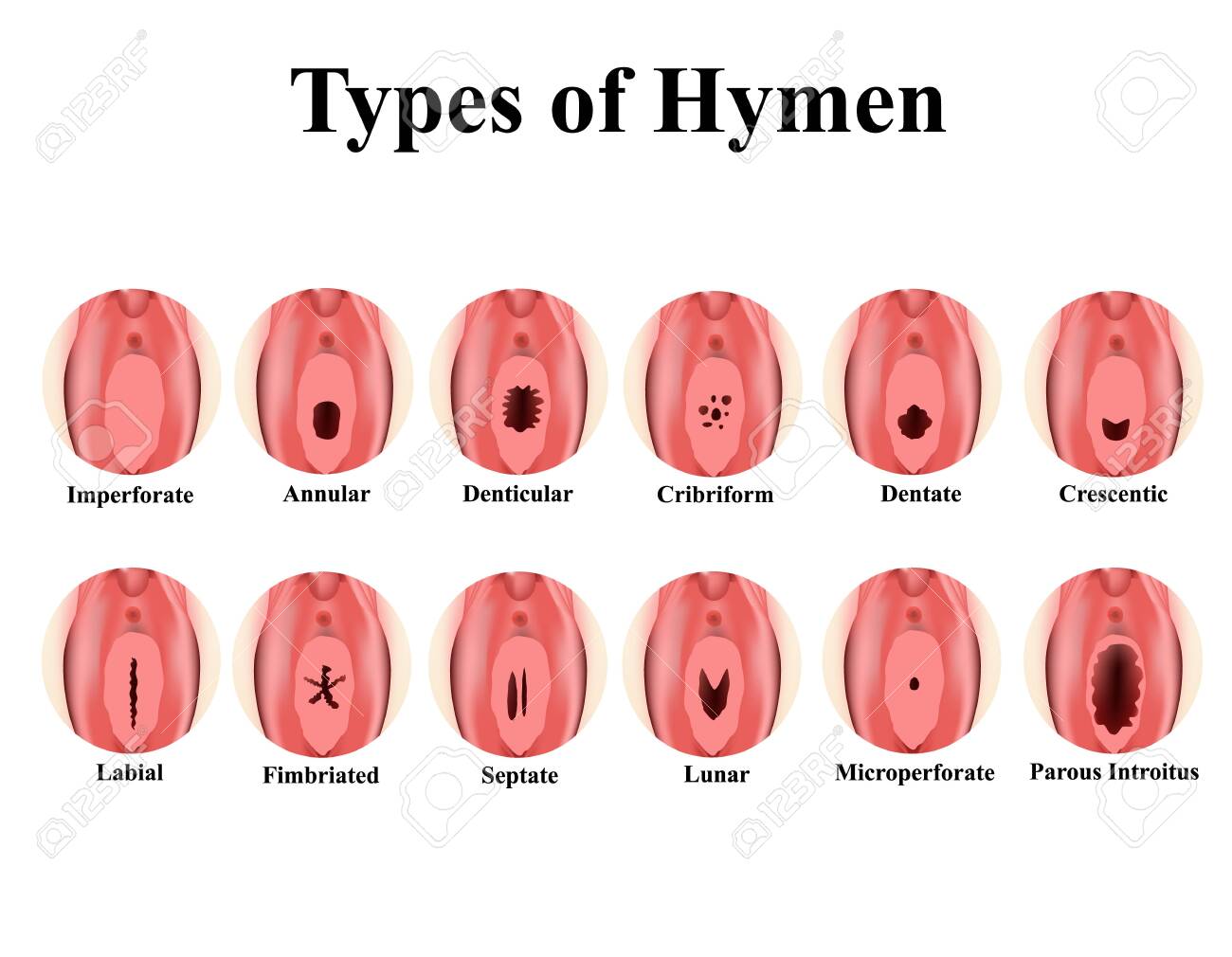 Types Of Hymen. Imperforate, Annular, Denticular, Cribriform, Dentate,  Crescentic, Labial, Fimbriated, Septate, Lunar, Microperforate. Hymen After  Defloration. Infographics. Vector Illustration. Royalty Free SVG, Cliparts,  Vectors, and Stock ...