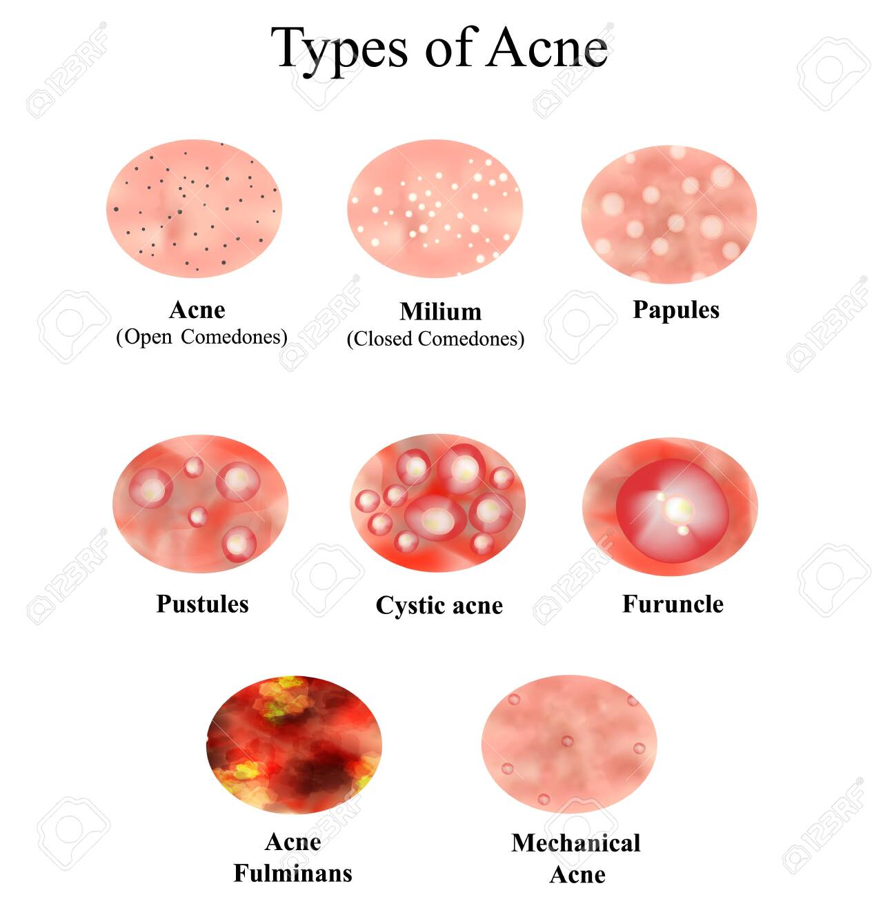 papules acne images