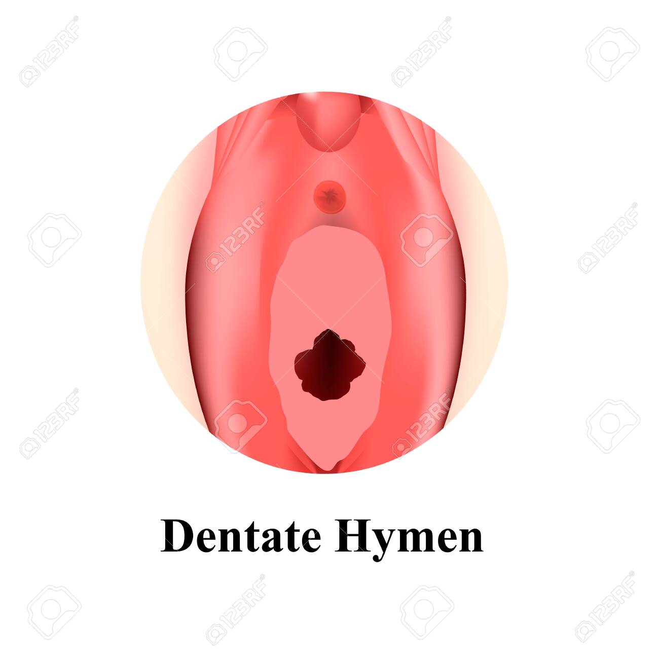 The Structure Of The Vulva Hymen Denticular. Hymen After Defloration.  Female Genital Organs. Infographics. Vector Illustration On Isolated  Background. Stock Photo, Picture and Royalty Free Image. Image 138240653.