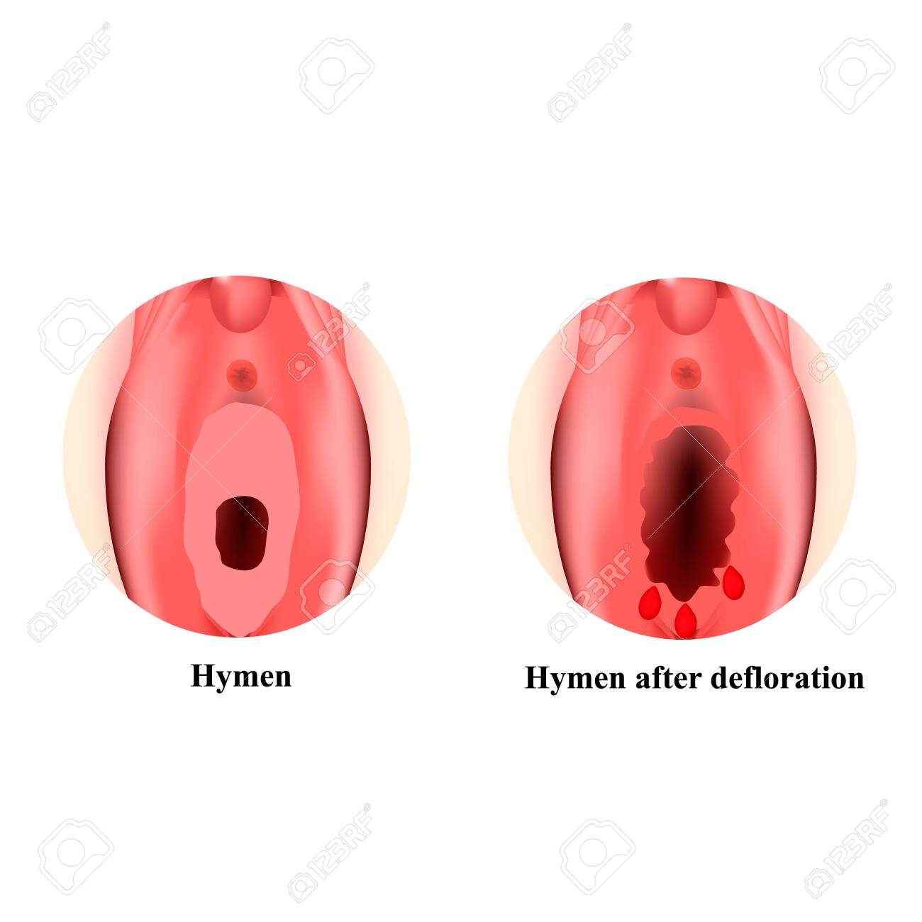 医学ビデオ 処女膜 外陰部の処女膜の構造。閉経形成術。脱食後の処女膜。女性の生殖器。インフォグラフィックス。分離された背景上のベクターの図。のイラスト素材・ベクター  Image 138240753