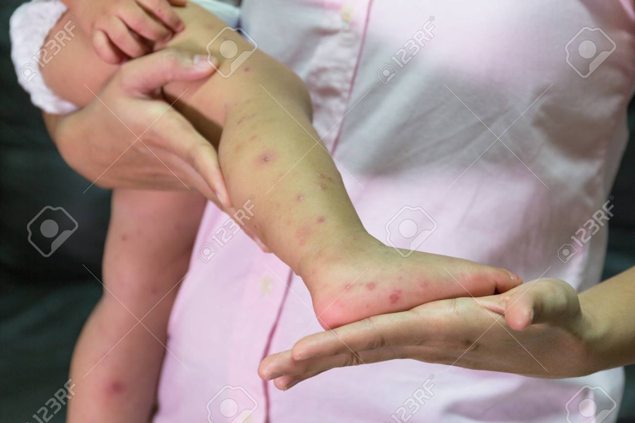 mano, fiebre aftosa, mucha picazón mano, fiebre aftosa, mucha picazón