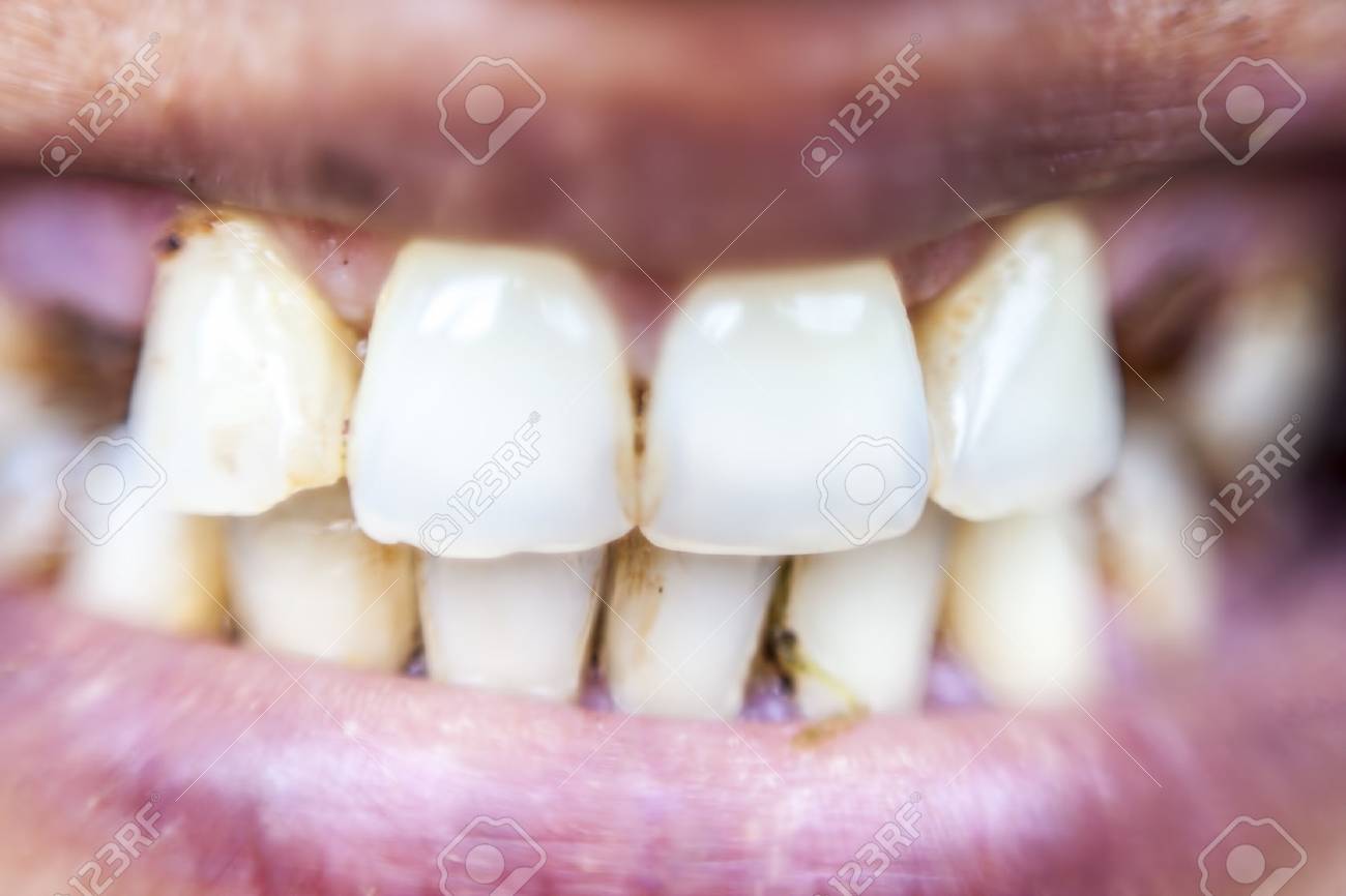 Dirty Female Teeth. Stock Photo, Picture And Royalty Free Image. Image  85309169.