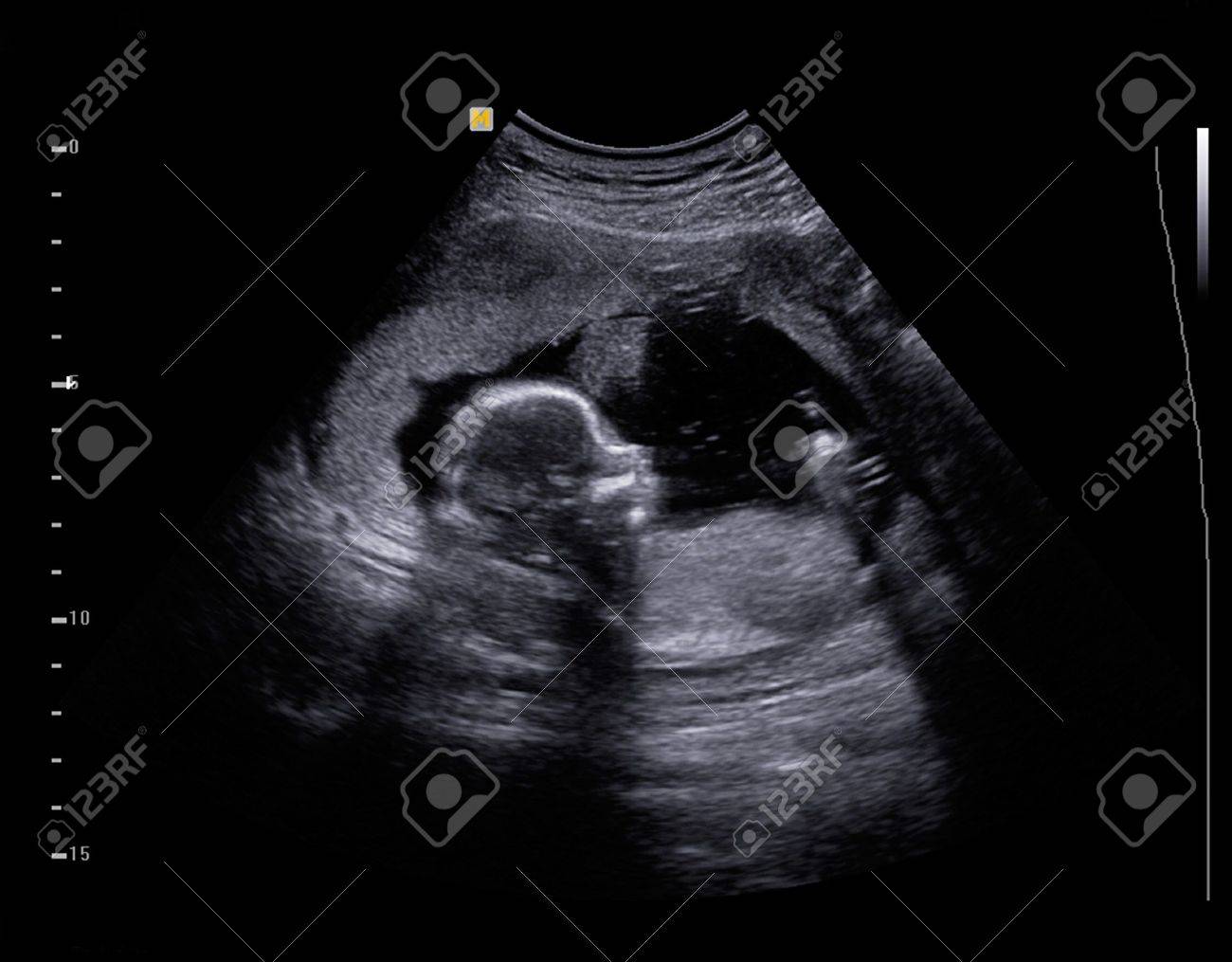 L Echographie De Bebe A Cinq Mois Banque D Images Et Photos Libres De Droits Image L Echographie De Bebe A Cinq Mois Banque D Images Et Photos Libres De Droits Image