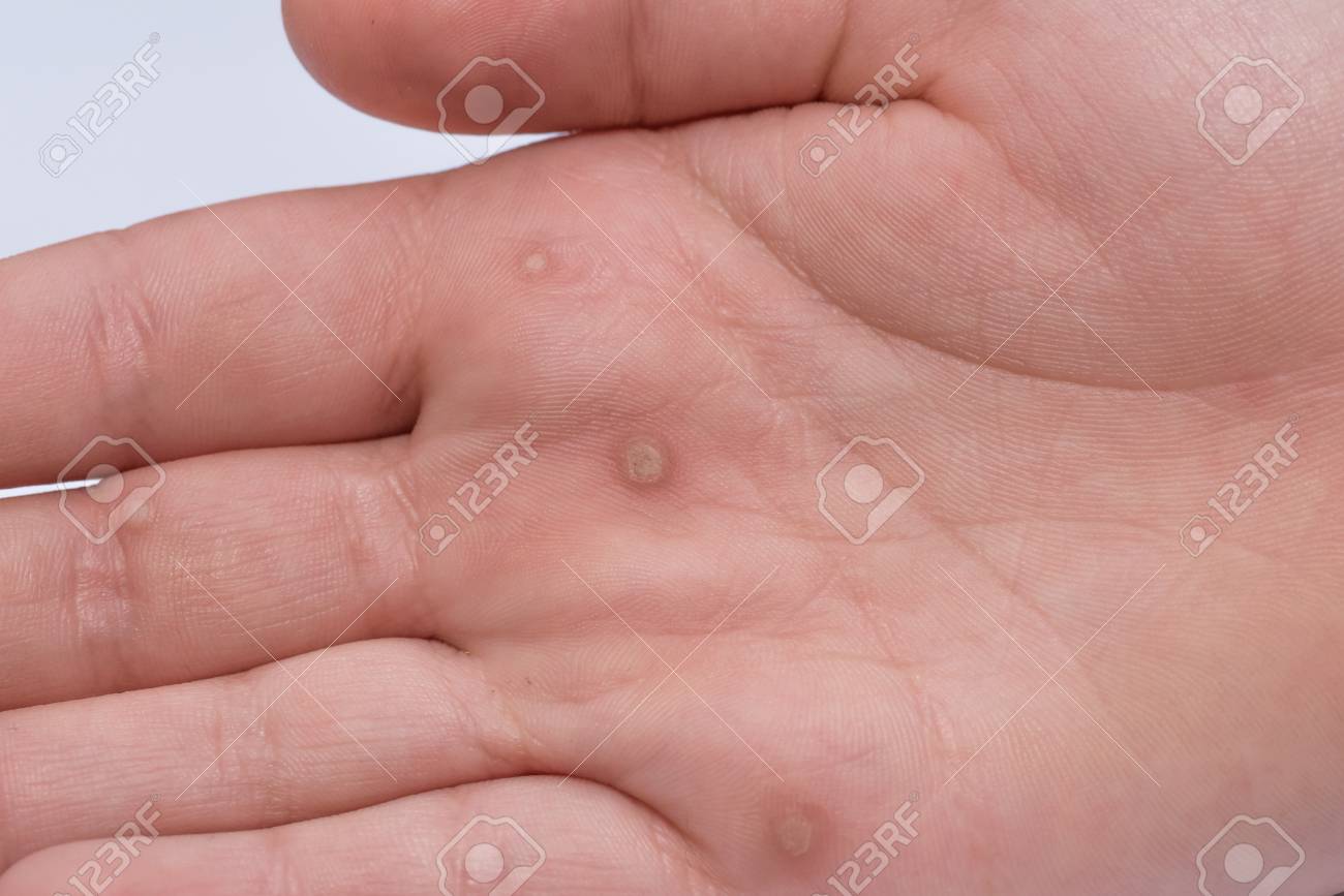 hpv szemolcs tialakulasa