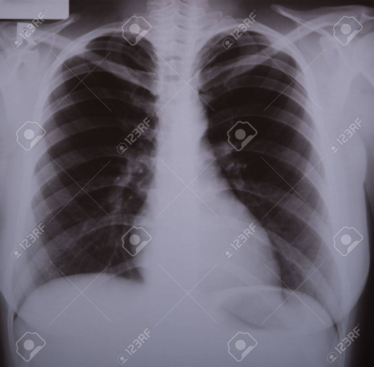X-ray Image Of Lungs With Light Two-sided Bronchitis Stock ...
