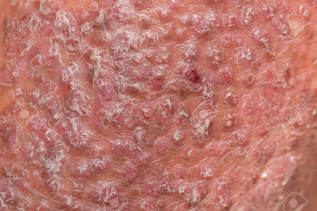 Psoriasis vulgaris g