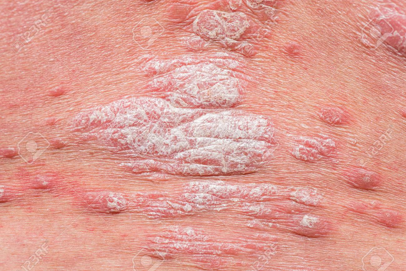 Tó tus pikkelysömör kezelése, éhezés gyógyítja psoriasis