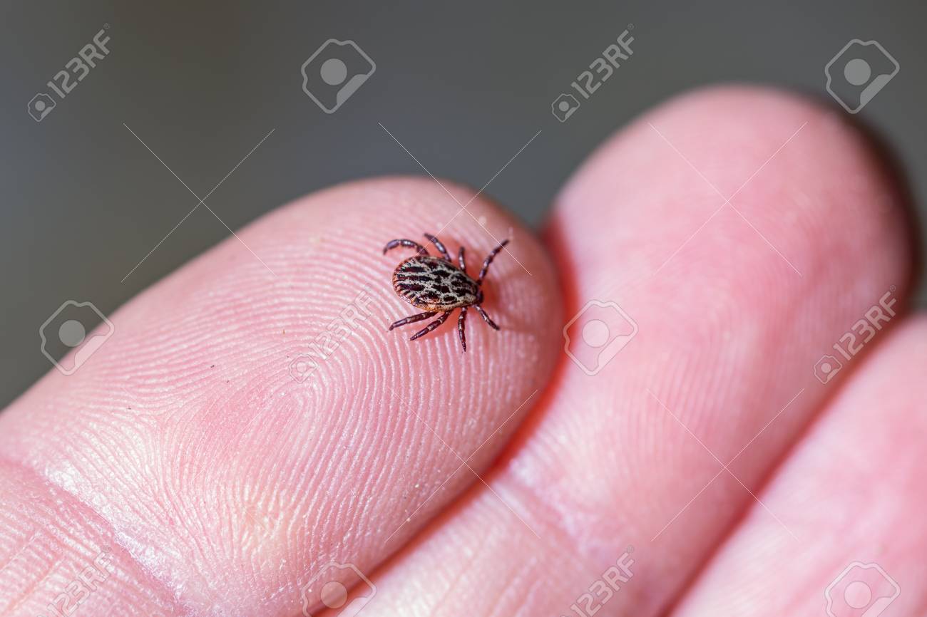 Closeup of a tick on a finger. - 87849470 Closeup of a tick on a finger. - 87849470