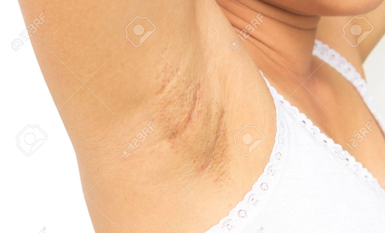 皮膚のケアと美容コンセプトの白い背景の上の女性問題黒脇 の写真素材 画像素材 Image