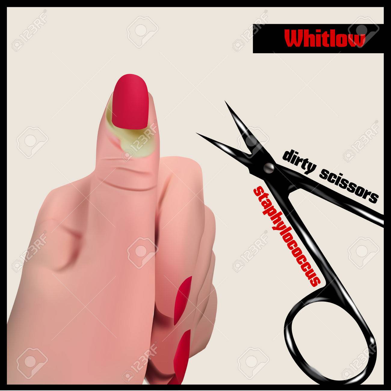 Panaricium ひょう疽 指の爪付近の軟部組織の膿瘍 のイラスト素材 ベクタ Image