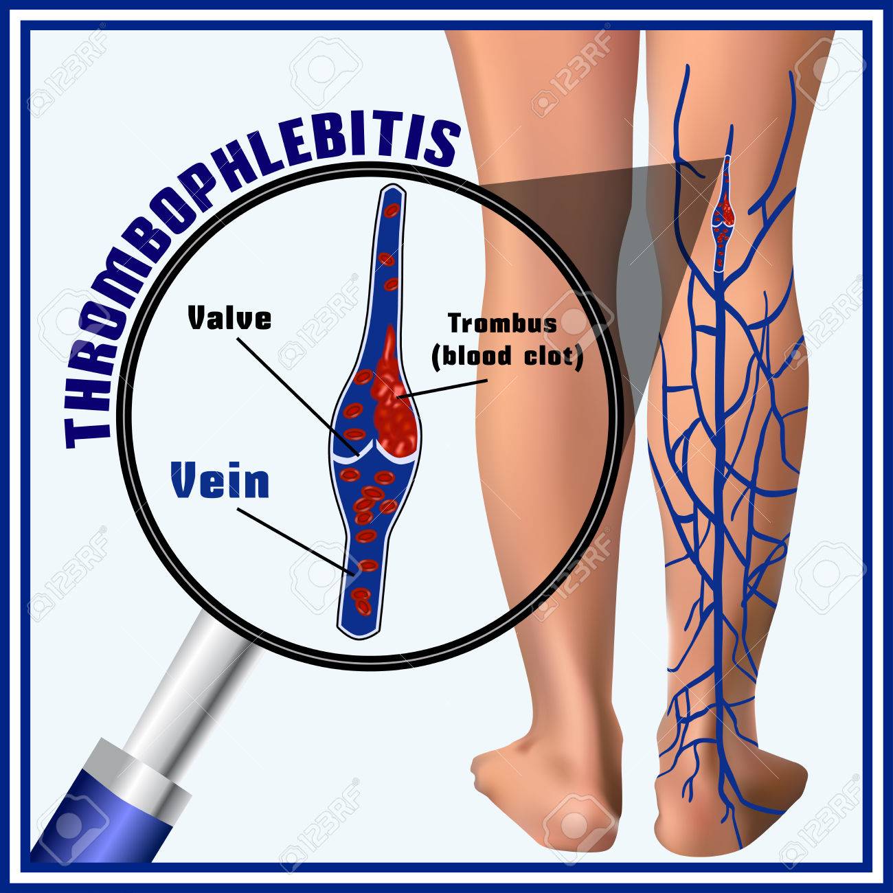 Thrombophlebitis Blood Clots In The Veins Embolism Thrombosis Royalty Free Cliparts Vectors And Stock Illustration Image 56909658