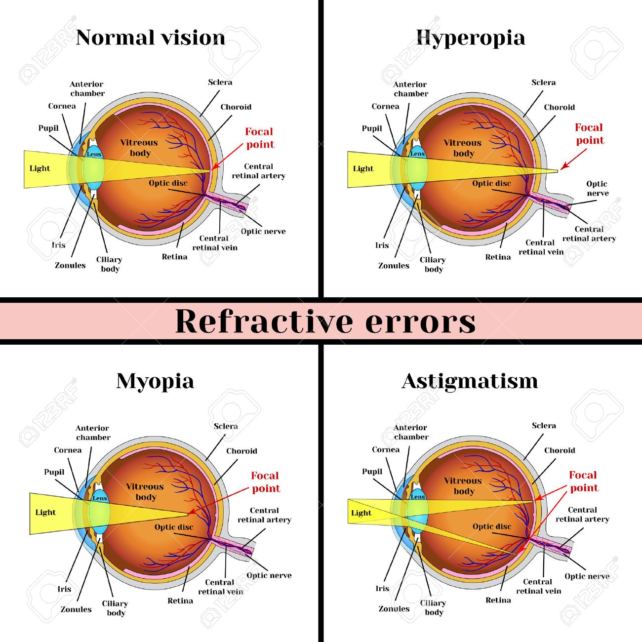 Resultado de imagen para errores de la refraccion