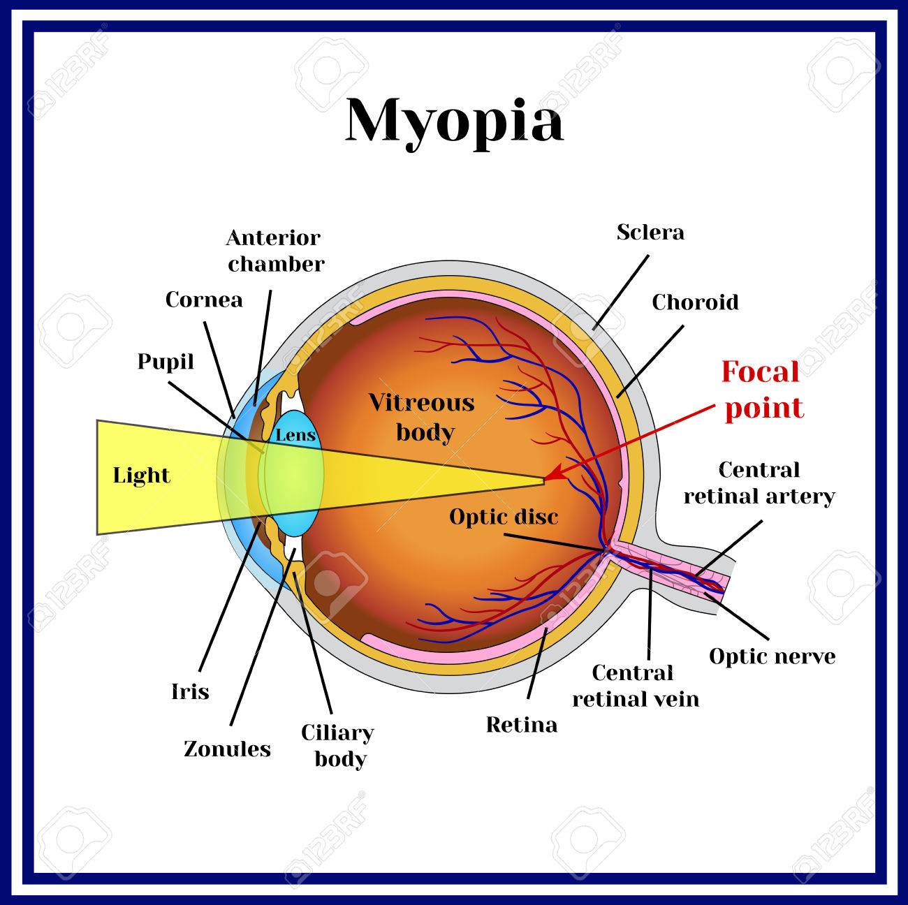 refractive errors eyeball myopia royalty free cliparts, vectors Astigmatic Error refractive errors eyeball myopia stock vector 68283535