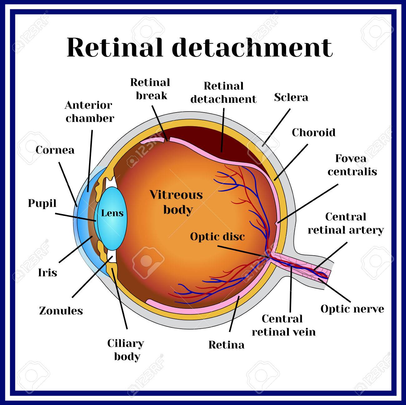 Retinal Detachment Of The Retina From Choroid Stock Vector Retinal Detachment Of The Retina From Choroid Stock Vector