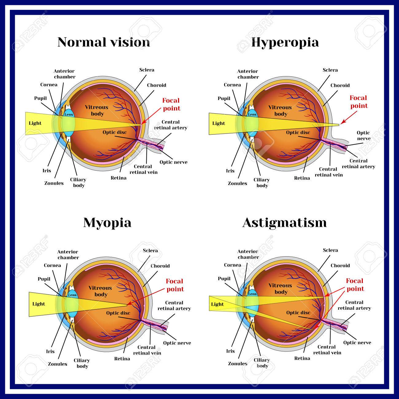 miopie astigmatism