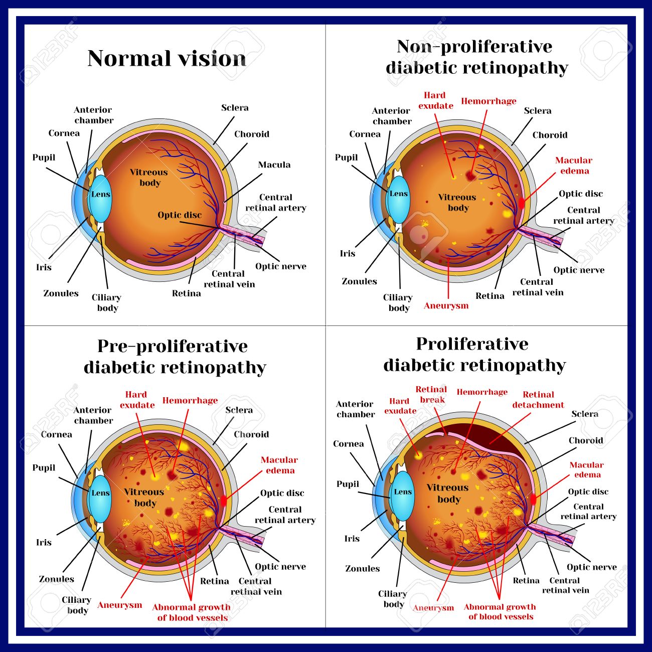 types of diabetic retinopathy non proliferative pre proliferative proliferative diabetic retinopathy