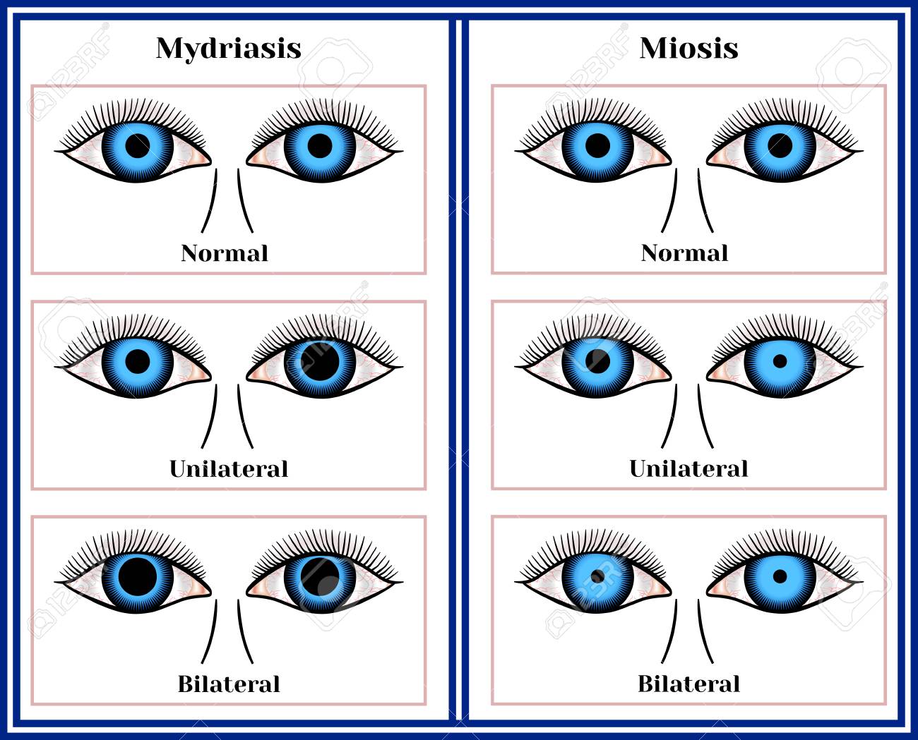 Mydriasis - Expansion Of A Pupil And Miosis - Narrowing Of A Pupil Chart Illustration. Royalty Free Cliparts, Vectors, And Stock Illustration. Image 92035764.