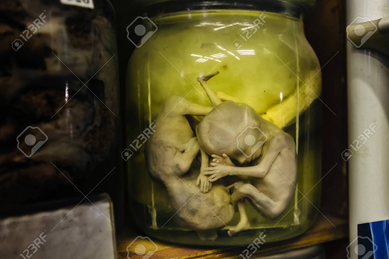 Fetus of human twins with pathology subcutaneous hemorrhage in jar with formalin - 129040394