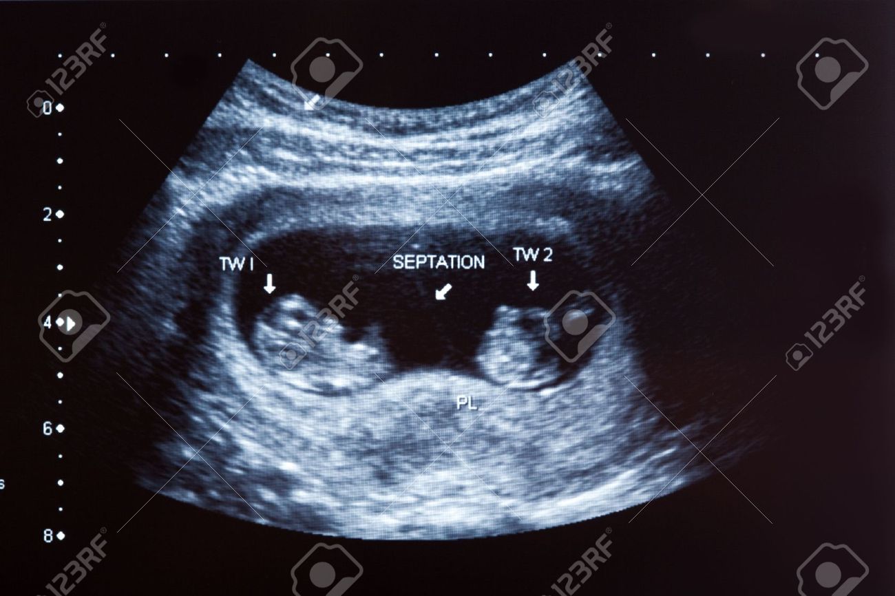 Ecografia De Dos Ninos Gemelos De 10 Meses De Edad Fotos Retratos Imagenes Y Fotografia De Archivo Libres De Derecho Image