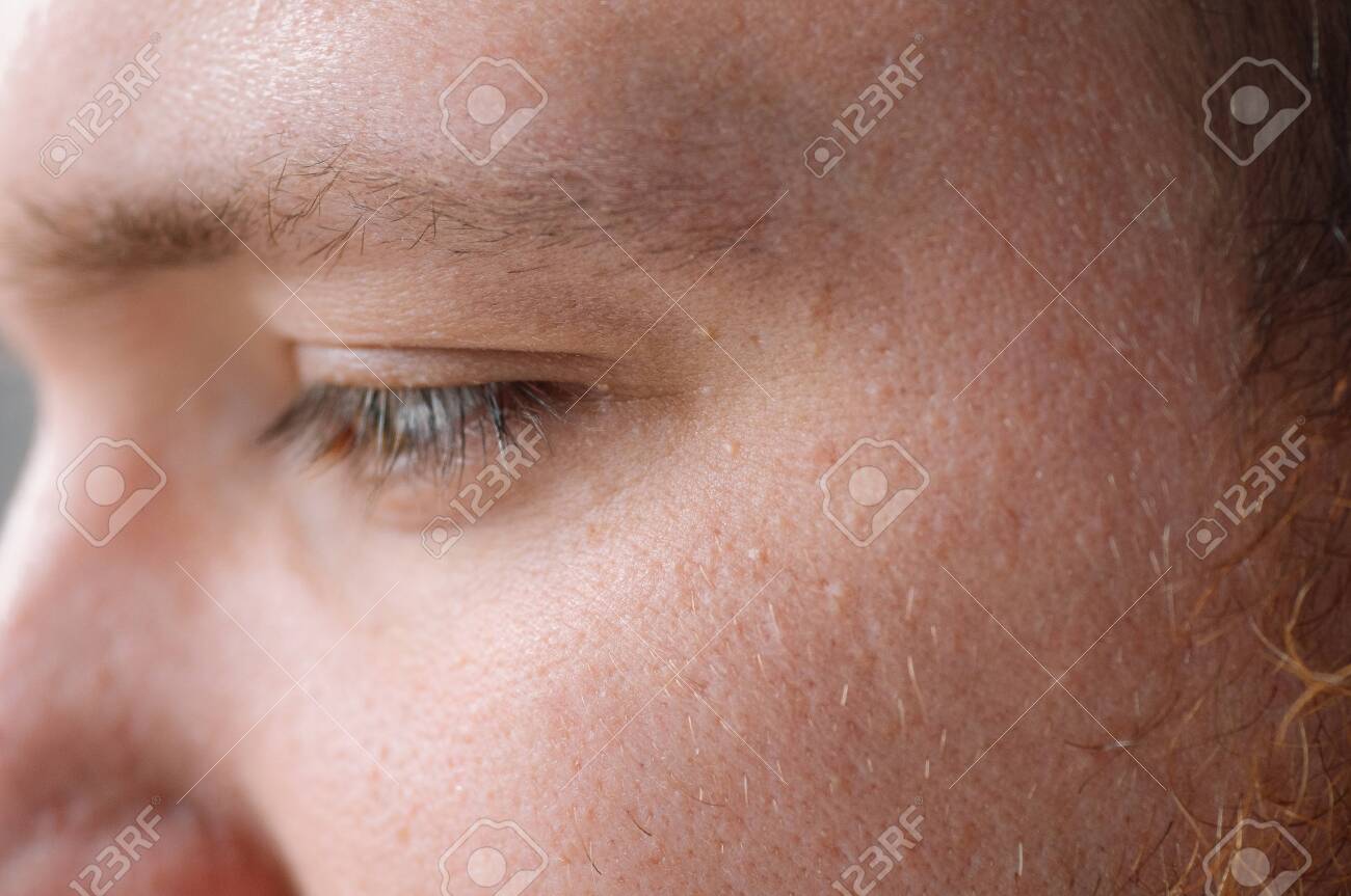 Milia (Milium) - Pimples Around Eye On Skin. Eyes Of Young Man With Small  Papillomas On Eyelids Or Growths On Skin. Face Closeup. Stock Photo,  Picture and Royalty Free Image. Image 144515708.