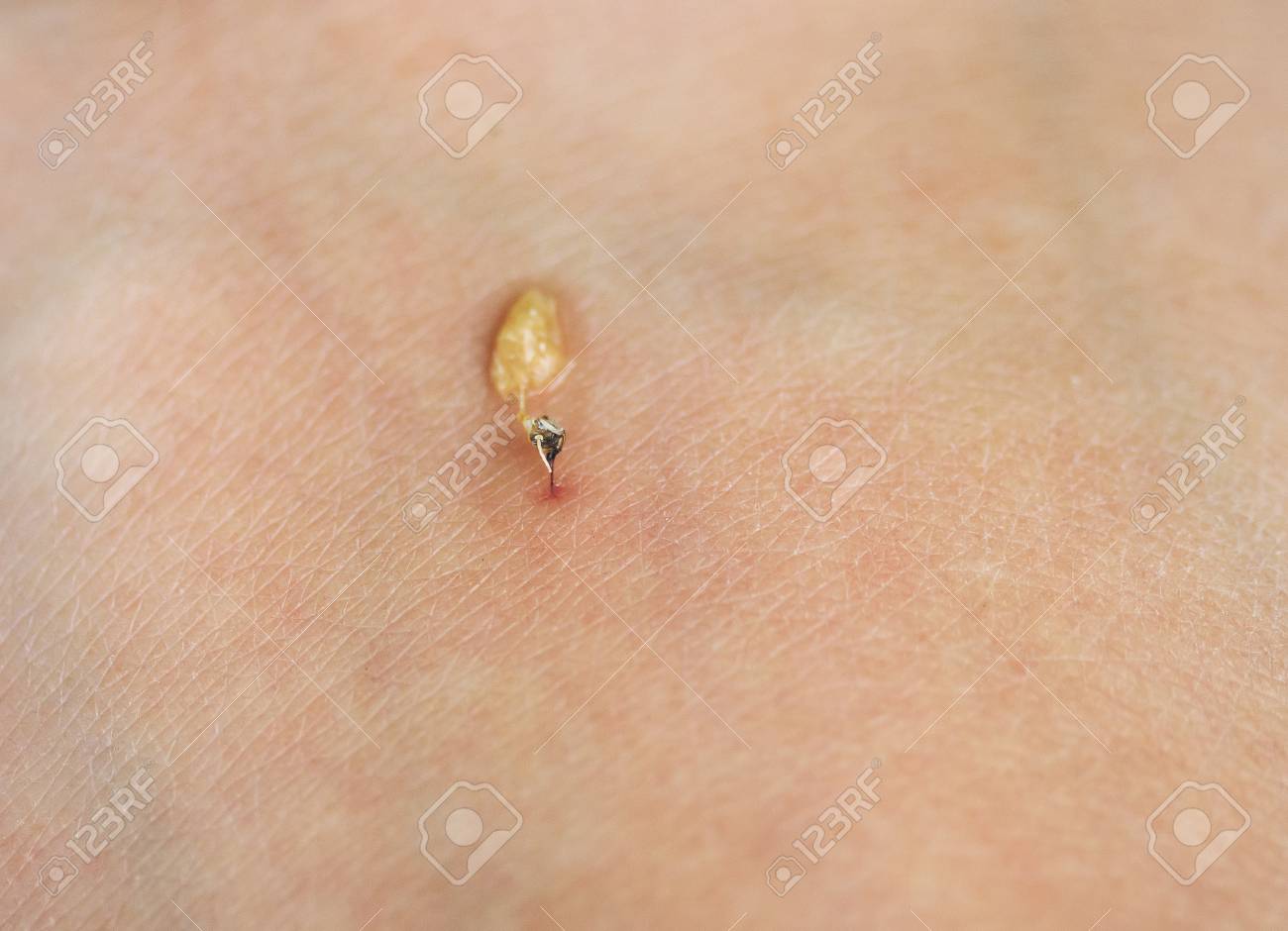 Sharp Bee Sting With A Bag Of Poison Pierced The Skin And Stuck Stock Photo Picture And Royalty Free Image Image 80434080
