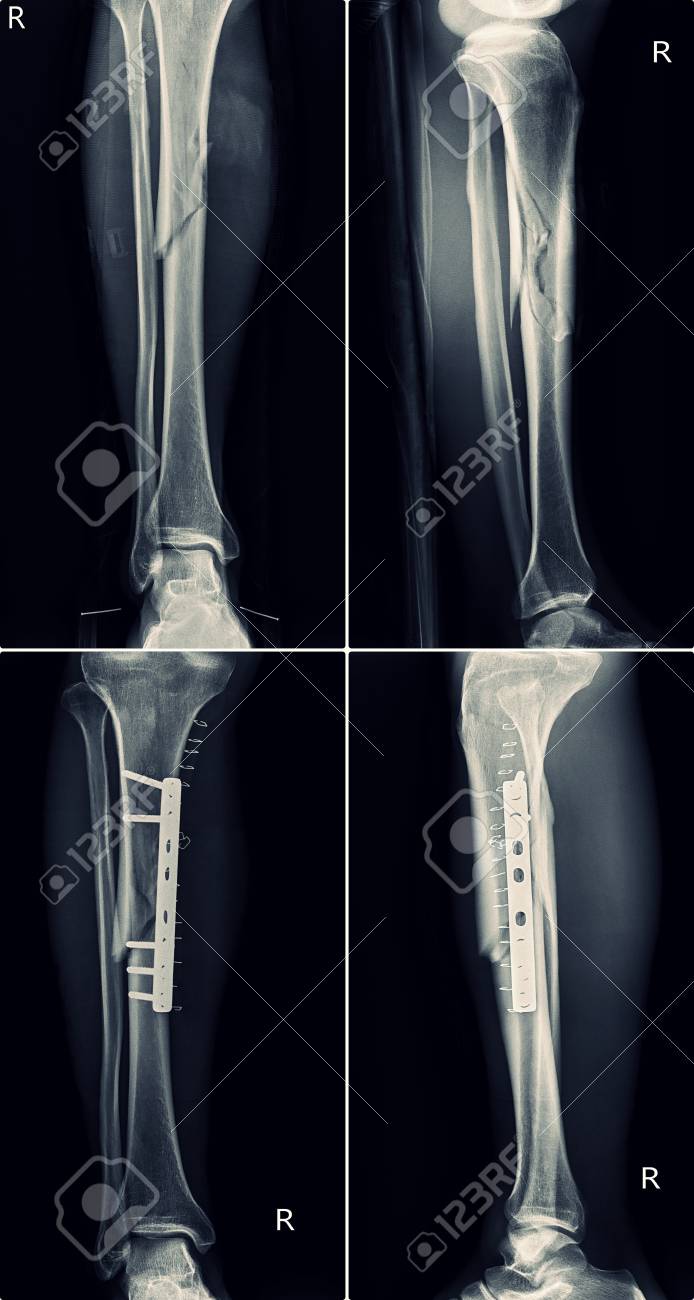 X-Ray Fracture Leg Before And After Treatment Stock Photo, Picture and  Royalty Free Image. Image 104145776., image size:694x1300