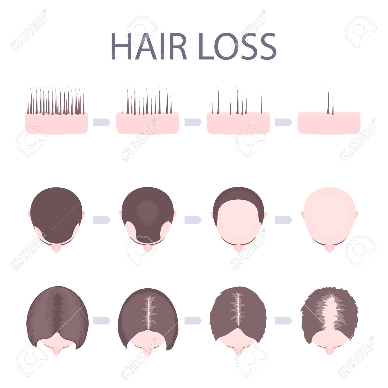 Male and female pattern hair loss set. Stages of baldness in men and women. Number of follicles on scalp in each step. Alopecia infographic medical vector template for clinics and diagnostics centres. - 95514985 Male and female pattern hair loss set. Stages of baldness in men and women. Number of follicles on scalp in each step. Alopecia infographic medical vector template for clinics and diagnostics centres. - 95514985