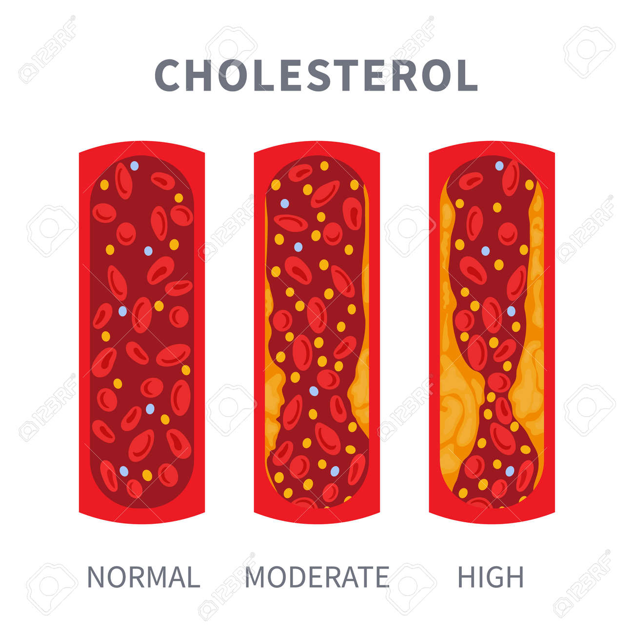Healthy And Narrowed Blood Vessel With Cholesterol Plaque Buildup. Artery  Blocked With A Fat Cells Clot. Ldl And Hdl Lipoprotein Comparison. Cross  Section Medical Diagram. Vector Illustration. Royalty Free SVG, Cliparts,  Vectors,, image size:1300x1300