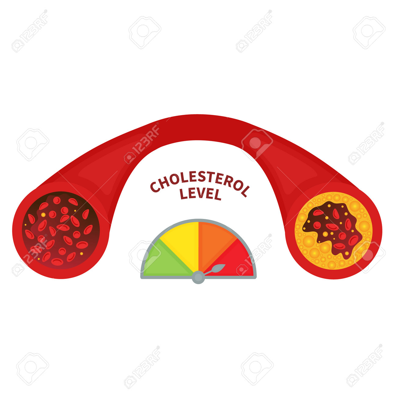 Cholesterol Level In Healthy And Blocked Blood Vessel Medical Diagram.  Meter Gauge Of Ldl And Hdl Lipoprotein. High And Low Fat Test Indicator.  Atherosclerosis Risk. Vector Illustration. Royalty Free SVG, Cliparts,  Vectors,, image size:1300x1300