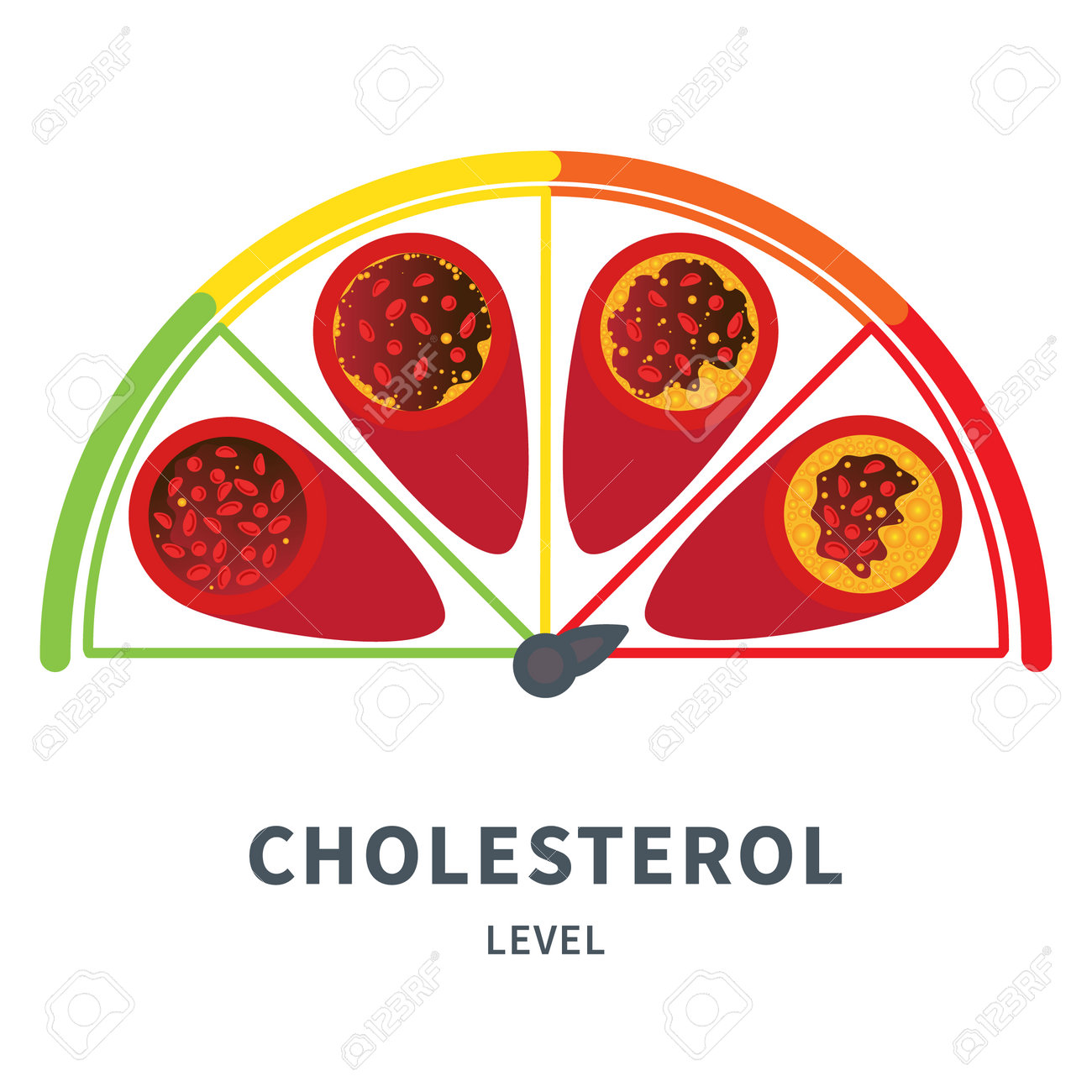 Cholesterol Level On Blocked Blood Vessel Medical Diagram. Atherosclerosis  Risk Scale. Meter Gauge Of Ldl And Hdl Lipoprotein. High And Low Fat Test  Indicator. Healthcare Concept. Vector Illustration. Royalty Free SVG,  Cliparts,, image size:1300x1300