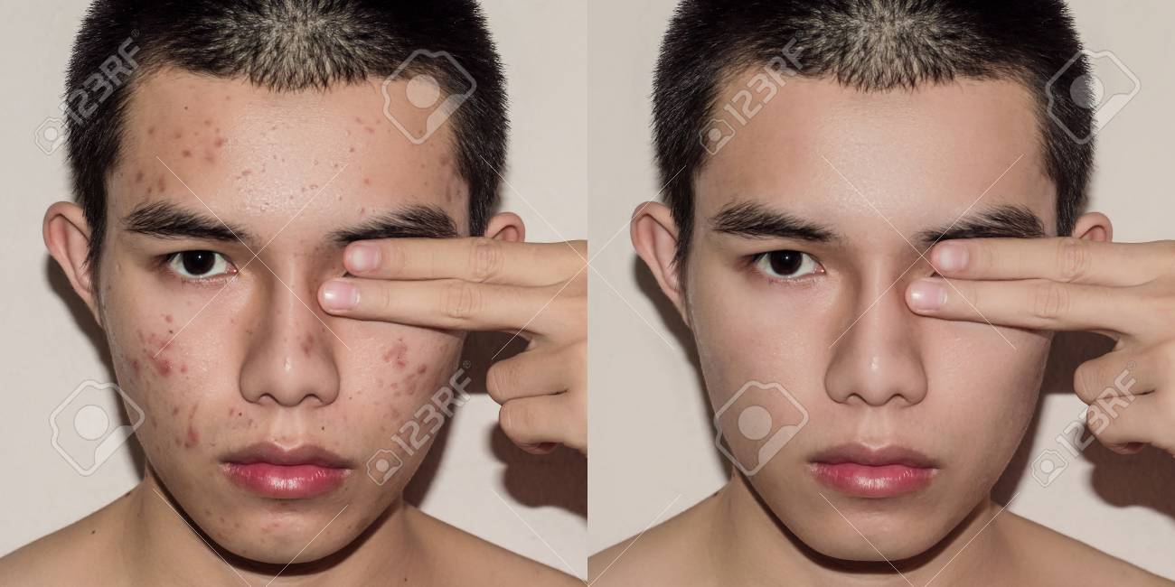 acne removal