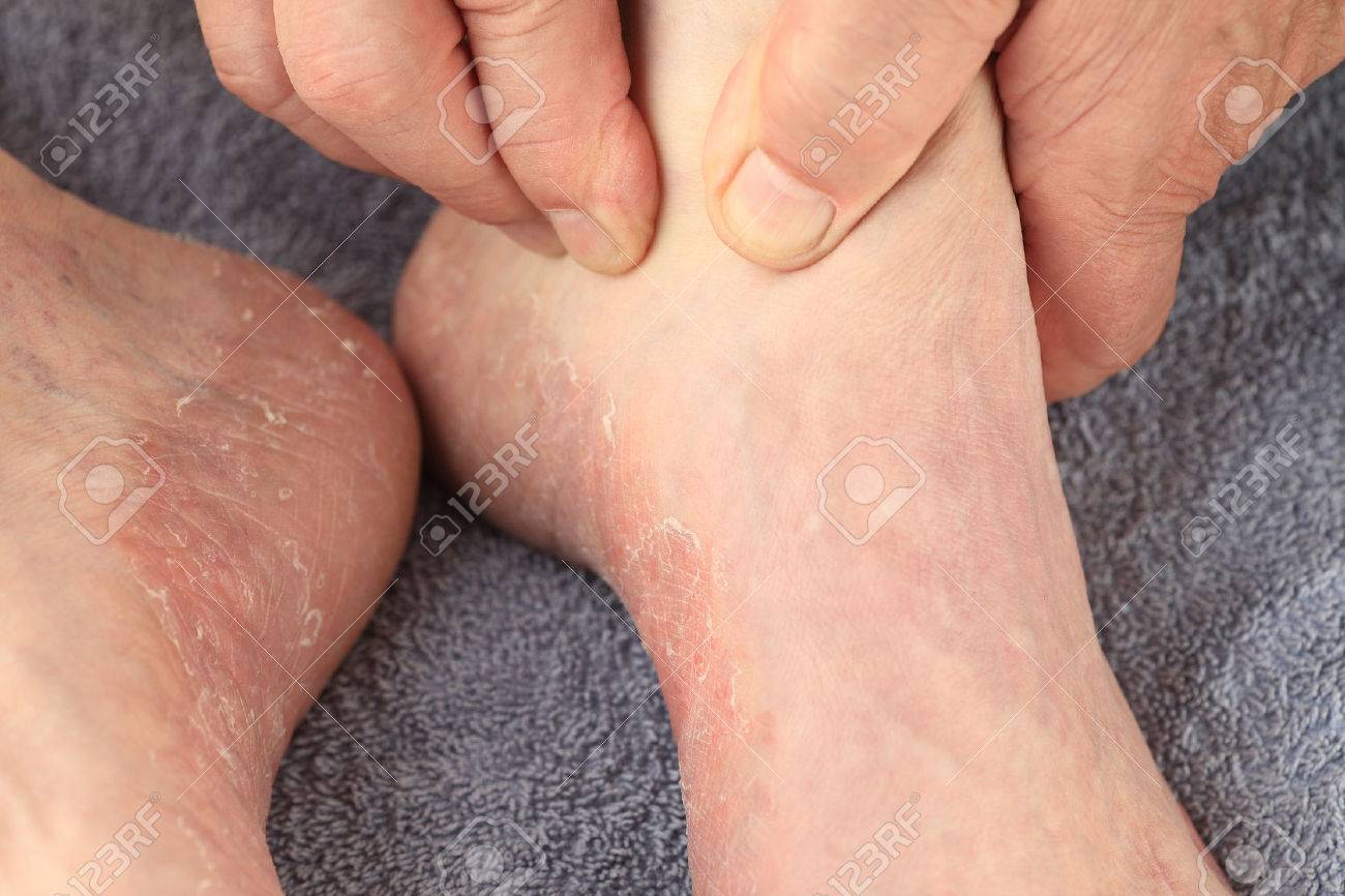 Un homme vérifie la peau rougie, sèche du pied d'athlète sur les deux pieds. Un homme vérifie la peau rougie, sèche du pied d'athlète sur les deux pieds.