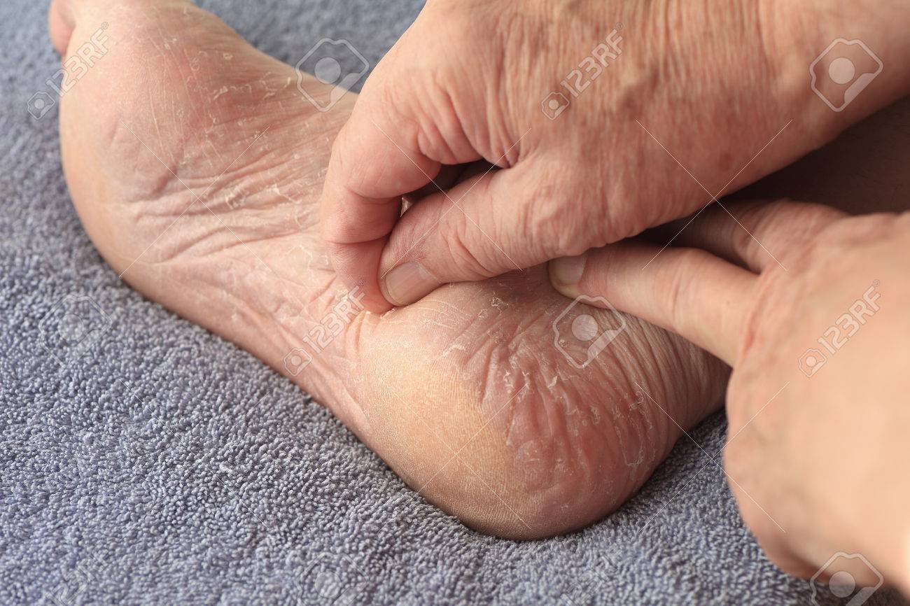 Un homme éplucher ses athlètes pied peau sèche Un homme éplucher ses athlètes pied peau sèche