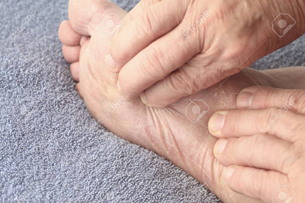 Un homme âgé vérifie la peau écaillée sec de pied d'athlète sous sa seule. Un homme âgé vérifie la peau écaillée sec de pied d'athlète sous sa seule.