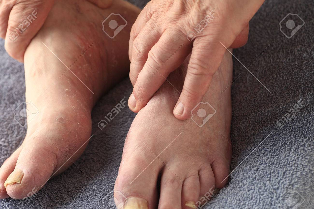 Les mains d'un homme sur ses pieds, dont l'un a la fois champignon de l'ongle et la peau sèche et une desquamation de pied d'athlète Les mains d'un homme sur ses pieds, dont l'un a la fois champignon de l'ongle et la peau sèche et une desquamation de pied d'athlète