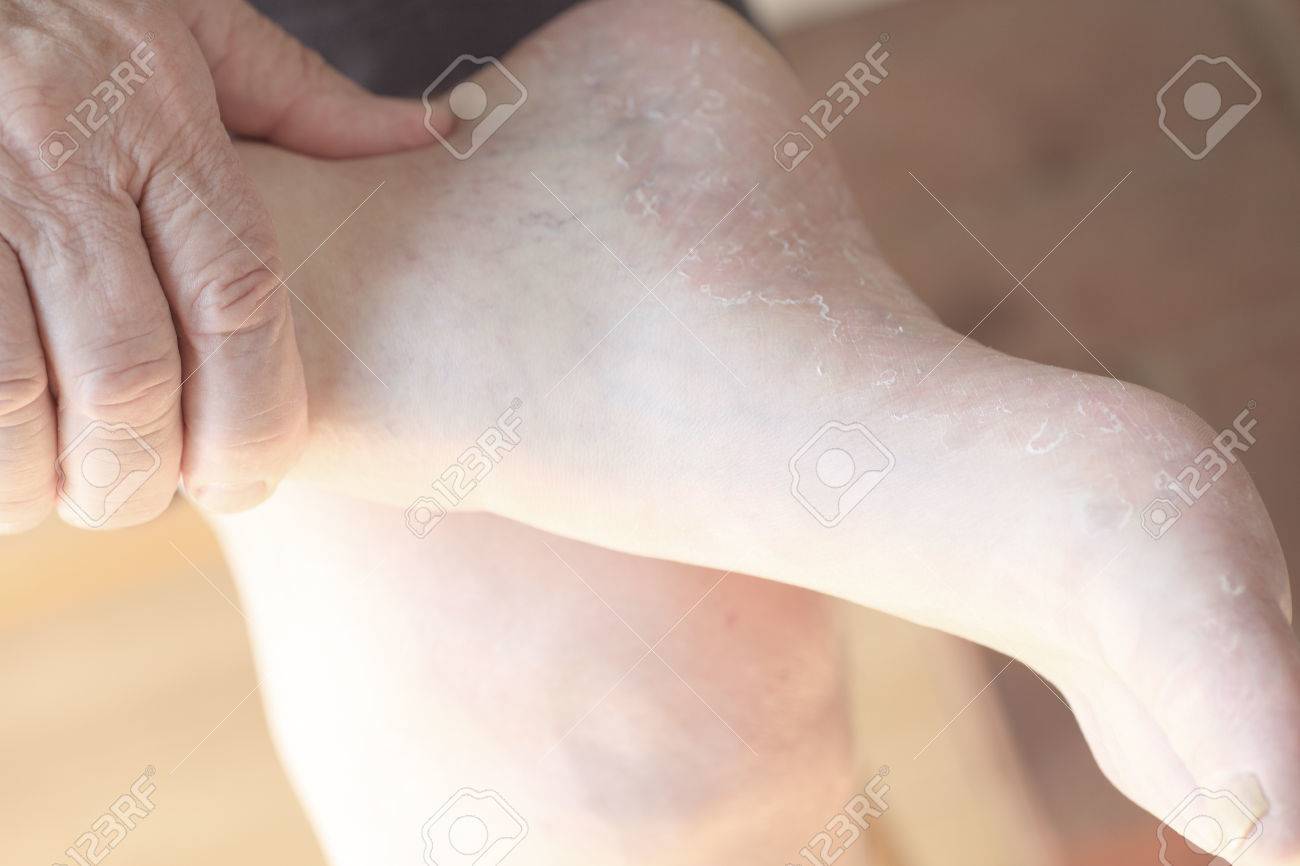 Un homme âgé vérifie la peau sèche et écaillée sur son pied. Un homme âgé vérifie la peau sèche et écaillée sur son pied.